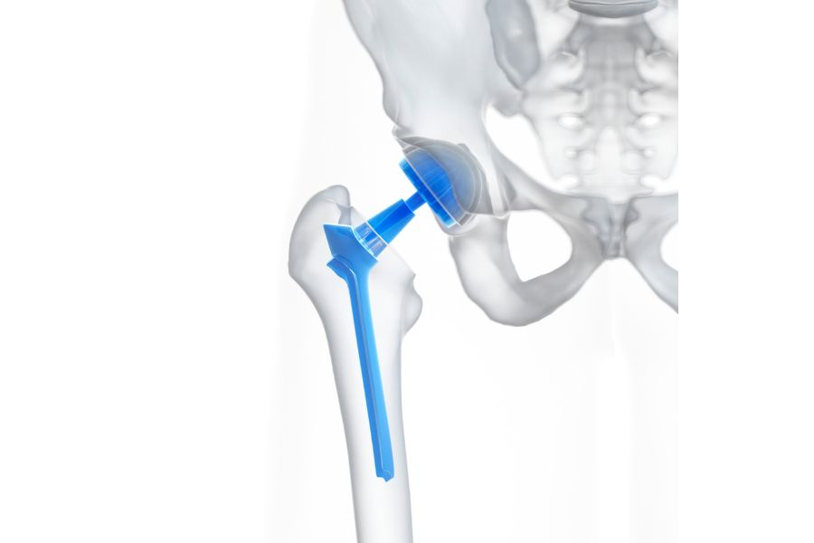 Intervention prothèse de hanche