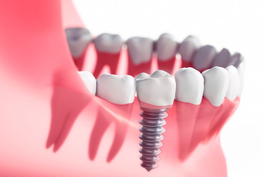implant dentaire inconvénient