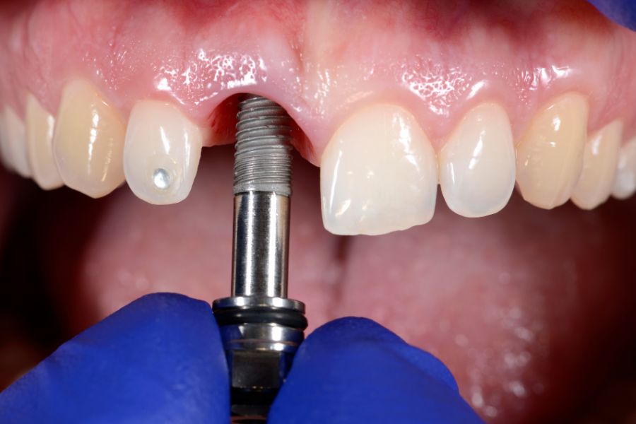 implant dentaire exemple