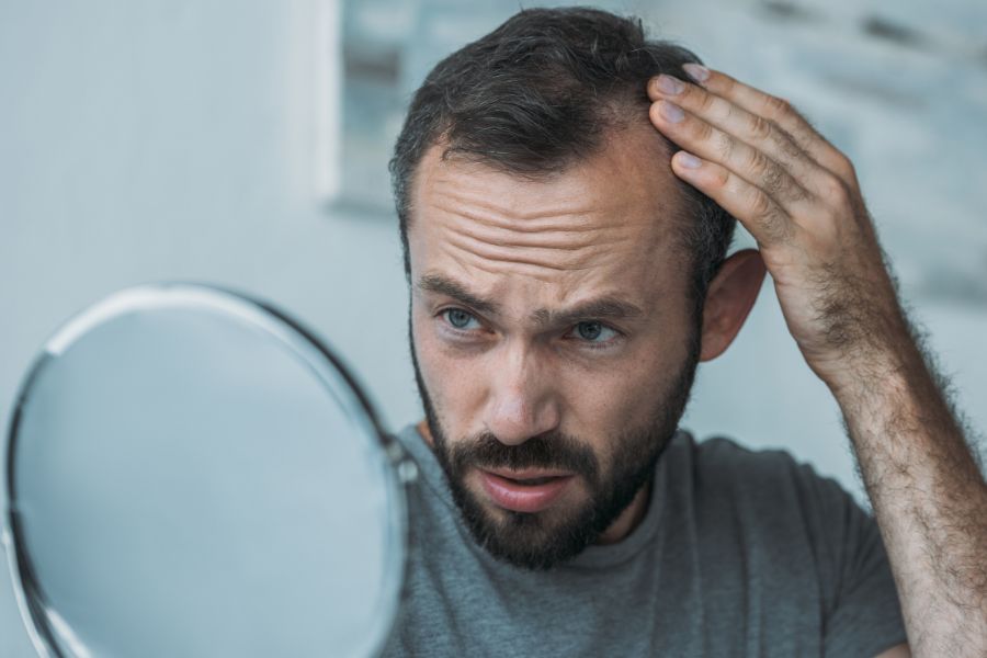 perte de cheveux homme