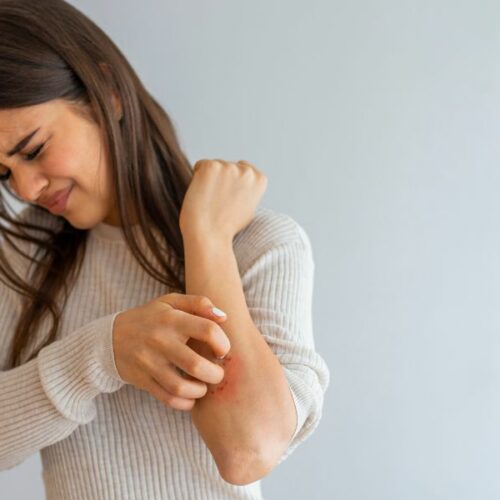 psoriasis