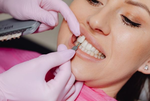 facette dentaire femme