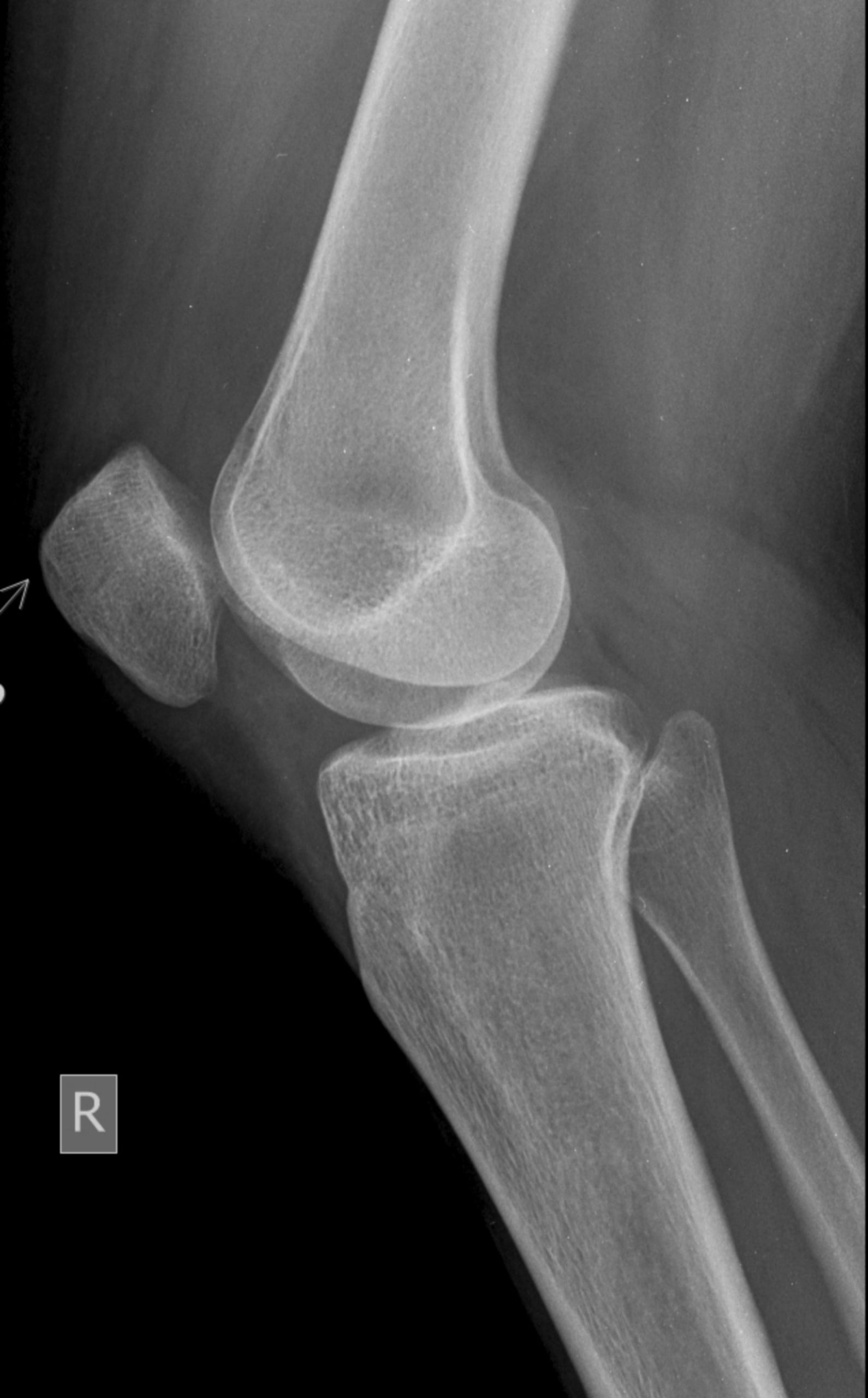 arthrose genou